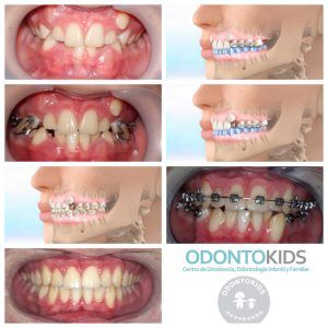 Ortodoncia rápida sin extracciones para niños y adultos en Odontokids Málaga